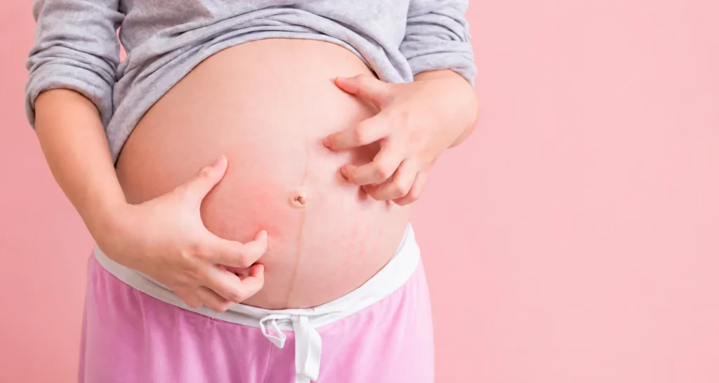 Rash around the abdomen